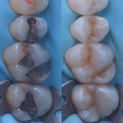 Long lasting white teeth