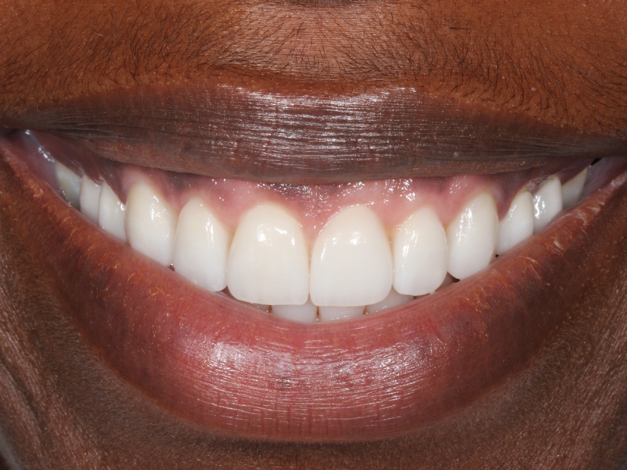 Periodontics, Gummy Smile, after